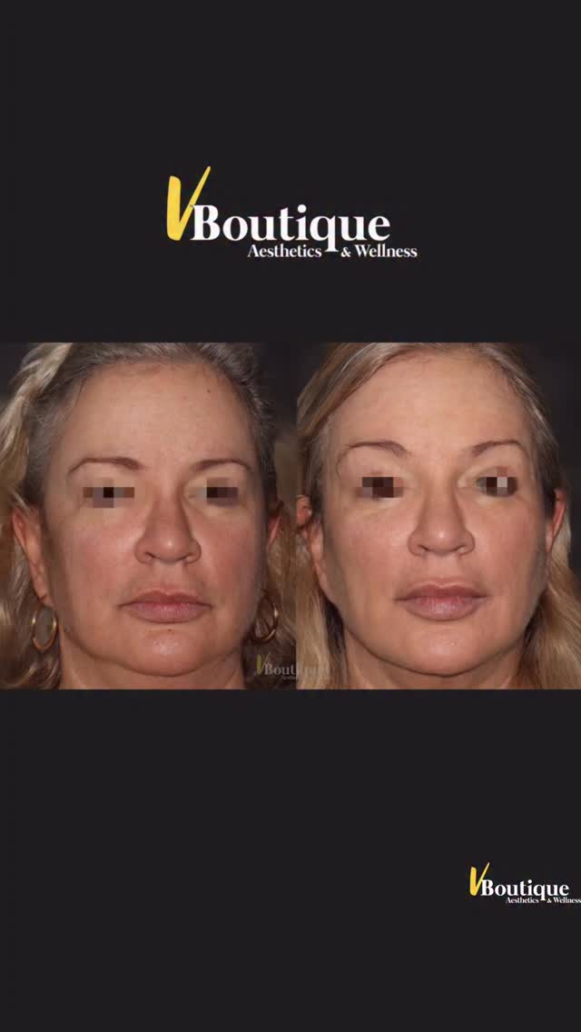 The best aesthetic work is the kind no one can point to. ✨
These photos are two years apart.
No drastic changes. No overfilling. Just thoughtful, gradual refinement.
Over time we combined:
💉 Dysport to soften lines and subtly lift
💎 Strategic hyaluronic acid filler in cheeks, jawline, lips & marionette area
✨ IPL to brighten skin, shrink pores & reduce pigmentation
⚡️Fotona Tightsculpting laser to tighten and reshape the jawline
🔬 SmoothEye + Vector Lift laser for eye rejuvenation & brow lift
🧴 Medical-grade skincare to maintain results
The goal is simple:
Look refreshed, lifted, and glowing — without losing yourself.
And she absolutely does. 🤍
#NaturalAesthetics
#FacialBalancing
#RefreshedNotFrozen
#Skinrejuvenation
#facialfilers