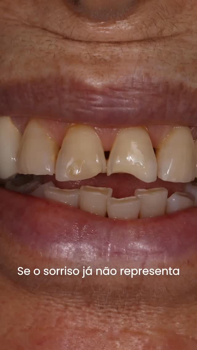 Há momentos em que um sorriso deixa de representar quem somos.
Neste caso, através de um planeamento clínico rigoroso e de uma reabilitação oral totalmente personalizada — combinando implantes, coroas e soluções estéticas — foi possível devolver função, harmonia e naturalidade.
Mas o verdadeiro resultado vai além da técnica.
É voltar a sorrir sem pensar.
É recuperar confiança.
É reconhecer-se novamente ao espelho.
Porque reabilitar um sorriso é, muitas vezes, transformar uma vida.
Se sente que o seu sorriso já não reflete quem é, talvez esteja na altura de dar o próximo passo: marque a sua consulta!
—————————————————————————————
There are moments when a smile no longer represents who we are.
In this case, through careful clinical planning and a fully personalized oral rehabilitation — combining implants, crowns, and aesthetic solutions — it was possible to restore function, harmony, and naturalness.
But the true result goes beyond technique.
It’s smiling without thinking.
It’s regaining confidence.
It’s recognizing yourself in the mirror again.
Because rehabilitating a smile is often about transforming a life.
If you feel your smile no longer reflects who you are, it may be time to take the next step: book your consultation.
#dentistry #smiletransformation #oralrehabilitation #maloclinic