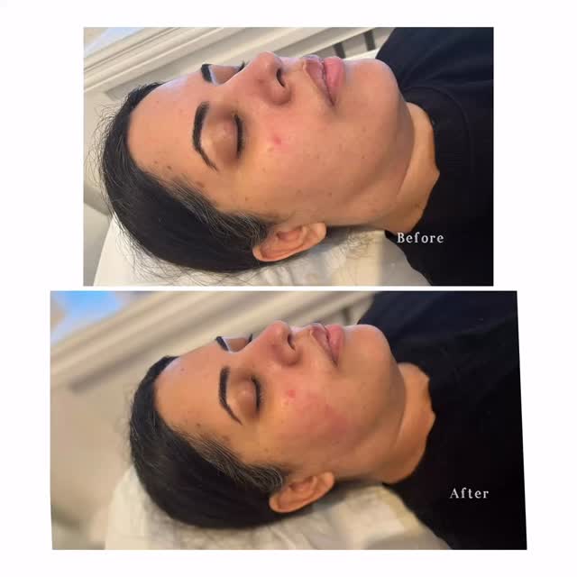 Before ➡️ After 1 HIFU Session
Natural lift.
Tighter skin.
Sharper jawline.
Ready for yours? 💌 Message us today.
