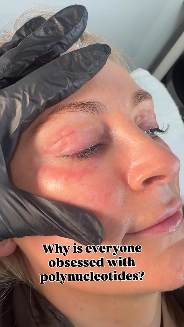 Polynucleotides are not about adding volume… they’re about rebuilding your skin from within.
This is regenerative aesthetics.
Stimulating fibroblasts.
Increasing collagen + elastin.
Improving skin thickness.
Restoring elasticity.
Repairing damaged tissue.
Perfect for:
• Under-eye crepey skin
• Acne scarring
• Ageing neck
• Sun-damaged skin
• Clients who don’t want more filler
The goal isn’t bigger.
It’s healthier. Stronger. More resilient skin.
This is collagen banking done properly.
Comment “REGEN” if you want to know if you’re suitable ✨
#Polynucleotides #skinclinic #antiaging #skincareroutine #aesthetics