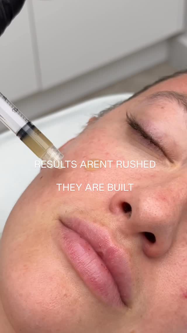 Results aren’t rushed, they are built.
In clinic, every treatment plan is approached with intention, clinical knowledge and respect for your individual anatomy and skin integrity.
Whether it’s collagen stimulating treatments, skin rejuvenation, medical aesthetic treatments, meaningful outcomes take time, consistency and the right indications.
There are no shortcuts in ethical cosmetic practice.
> No overpromising.
> No unrealistic timelines.
Just personalised assessment, informed consent, and evidence-based treatments tailored to you.
Skin quality improves gradually as your body responds. Cosmetic treatments are carefully planned, not impulsively performed. Because longevity, balance and safety will always matter more than instant gratification.
Results may vary between individual and a consultation is always undertaken prior to any treatment to determine suitability.
Book Now via Link in Bio
