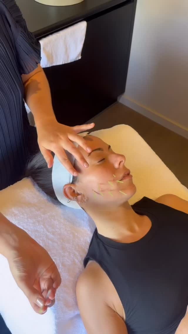 🪡 Cosmetic acupuncture is a targeted facial acupuncture technique that uses very fine needles to create a controlled micro-stimulation in the skin and facial tissues. This triggers your body’s natural repair response, helping to improve circulation, support collagen and elastin production, and restore healthier skin function over a series of treatments.
What it can help with:
•Collagen induction to support firmness and skin resilience
•Improved microcirculation to enhance glow and brightness
•Acne support by reducing inflammation and improving skin healing
•Post-acne scarring and uneven texture by encouraging tissue repair
•Pigmentation and uneven tone by supporting healthier skin turnover
•Fine lines and early signs of ageing by improving hydration, tone, and skin density
Results are cumulative, and treatment is best done as a series, tailored to your skin goals.
👉 DM “Cosmetic Acu” to start your journey to natural glowing skin.
#cosmeticacupuncture #acupuncturefacial #naturalantiaging #acnescarring #glowingskin