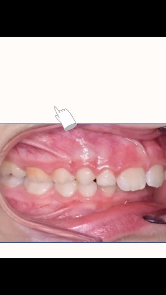 Aspettare che tutti i denti permanenti erompano
non eā sempre la soluzione miglioreā¦
Vuoi approfondire lāargomento?
Info@orthopiu.it
#ortodonzia #ortodonziaintercettiva #miofunzionale