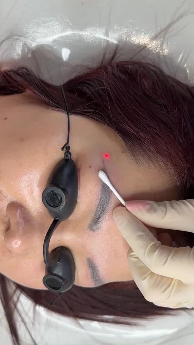 💁♀️Love seeing these tattooed pigment got lighter right away!!!
#browtattooremoval #tattooedbrows #laserremoval #eyebrowtattooremoval #wellington