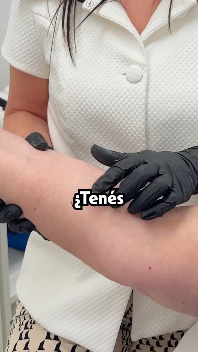 🔴 ¿Tenés un puntito rojo que no desaparece? Podría ser un Nevus Rubí.
Los nevus rubí (también llamados angiomas rubí) son pequeñas lesiones vasculares benignas muy frecuentes que aparecen con el paso del tiempo en el cuerpo.
✨ La buena noticia es que se pueden tratar de forma rápida y segura con láser Long Pulse.
✔️ Procedimiento rápido
✔️ Prácticamente sin dolor
✔️ No deja cicatrices
✔️ Resultados visibles desde la primera sesión
El láser actúa selectivamente sobre los vasos sanguíneos, eliminando el punto rojo sin dañar la piel sana que lo rodea.
Si notás que te aparecen estos puntitos rojos o querés mejorar el aspecto de tu piel, consultá con tu dermatóloga para evaluarlos correctamente.
📲 Turnos y consultas: 1166662866
#NevusRubi
#LaserDermatologico
#PielSana
#Dermatologia
#CuidadoDeLaPiel