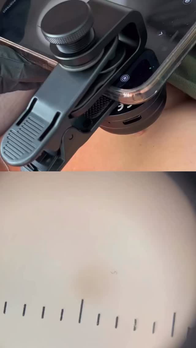 Did you know you can have a mole checked here at London Road Clinic 🔍
Worried about a mole or skin lesion and keep putting it off because you don’t want to wait?
Our mole checking service gives you fast access to a UK consultant dermatologist’s opinion using high-quality dermoscopic images captured at London Road Clinic and securely reviewed via Map My Mole.
You’ll receive a clear report with reassurance, advice to monitor, or a recommendation for referral - typically within 24-48 🤍🔍
Contact us and get your mole and lesions checked with our advanced practitioner and dr 👩🏼⚕️👨🏻⚕️
📍London Road Clinic: 65 London Road, Newark NG24 1RZ
📞 01636 680767
📧 hello@londonroadclinic.com
🔗 Booking link in bio