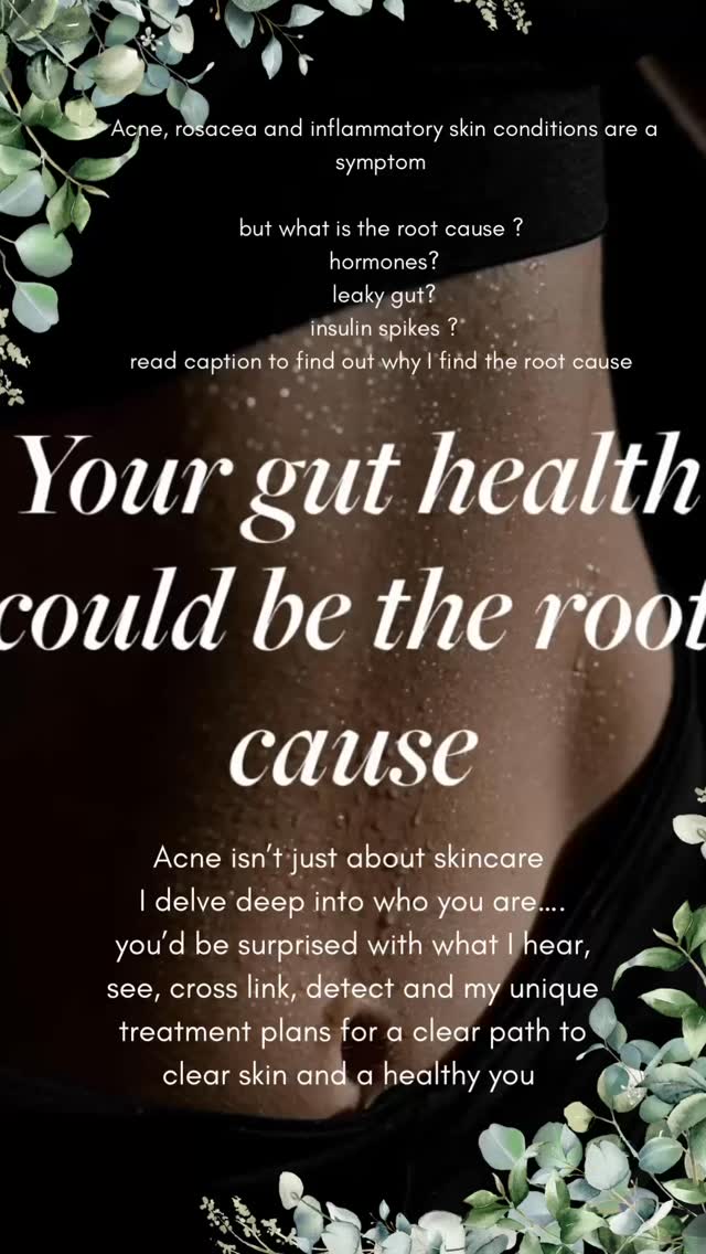 Understanding the root cause of your skin is everything!
Your skin is a symptom of an imbalance internally. It is also fuelled by hormones, stress, sun exposure and many more factors.
I now have my clients on a treatment programme to support them make understand , address and change their internal balance , keeping the skins PH level happy and more.
Acne, skin which flares up, rosacea, pigmentation , eczema, etc needs a structured plan with consistently. Not motile products.
If there was a magic 🪄 pill us advance skin specialists would all be out of a job!
DM if you are ready to book your consultation and be part of creating your tailored skincare plan
Anna ❤️
#acne #acnetreatment #leightonbuzzard #skintreatment #skinspecialist