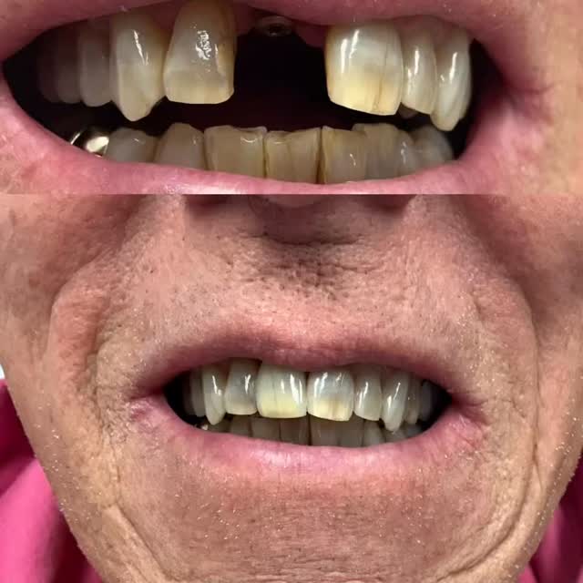 When asked to replicate a difficult-shade from pictures instead a live session for such a complex case… the challenge is accepted and passed with flying colors!
One of our services at Precision Esthetics is Custom Shade Taking, btw, and with experience comes mastery, and experienced Master Ceramists we have!
Look at the level of characterization, translucency, and detail that makes this into another successful restoration.
Thank you to @dochollidaydental for sharing the before and after pictures!