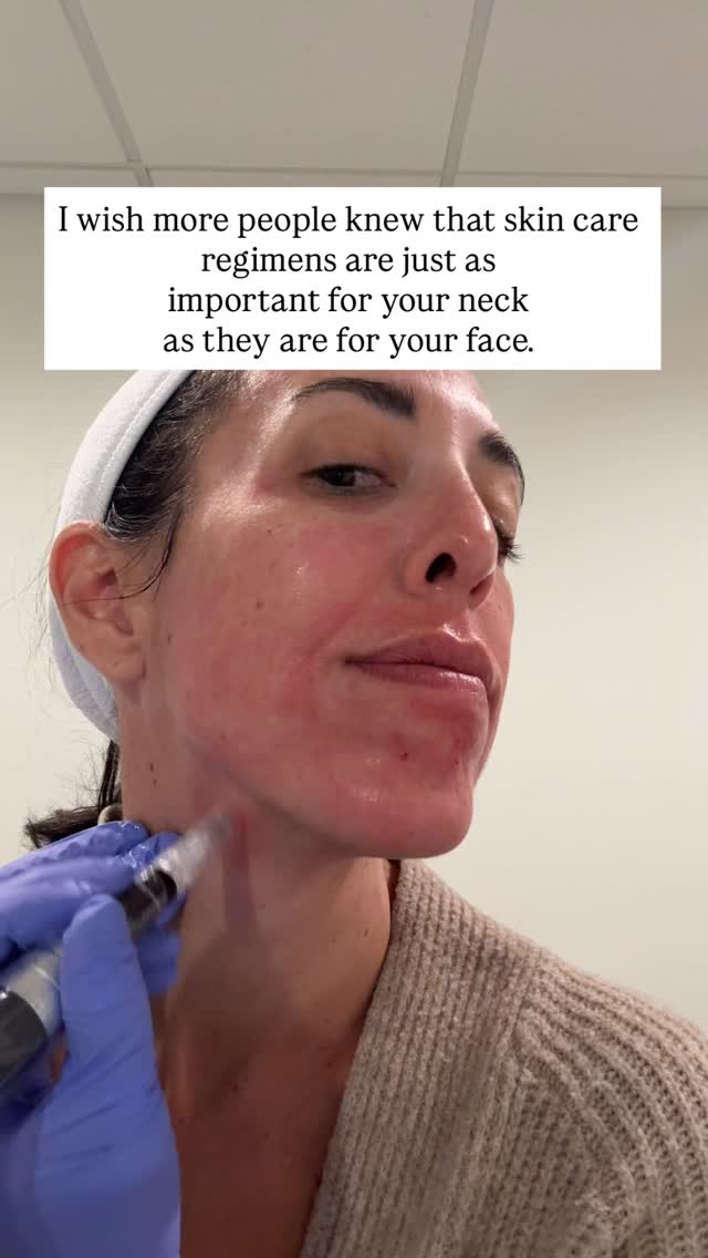 š£Don't forget your neck! I always tell my patients to make sure they are putting their skin care products (retinol, Vitamin C, SPF) on their neck as well!
.
Our neck is an area that can show our age more than our face, so it's very important to take care of it. When you have a microneedling treatment at Allure, your neck is automatically included in the treatment because I want you to age like a fine wine, neck included!
āļøBOOK WITH ME āļø
š»www.allureaw.com
š 563-258-4698
š§ info@allure-dbq.com
.
āļø FOLLOW ME āļø
Nicole Powers, ARNP, AGNP-BC
@nicolepowers_np
Allure Aesthetics + Wellness
@allure_iowa
#dubuque #nursepractitioner #dubuqueiowa #microneedling #medspa