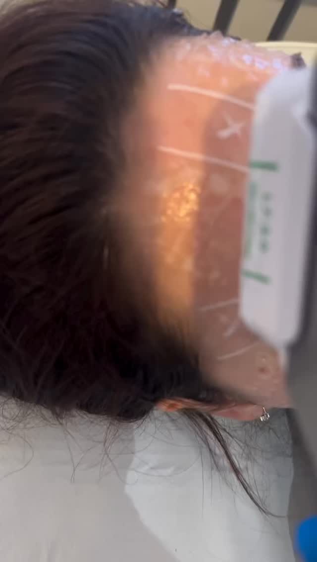 Thinking about a facelift but not ready for surgery? 👀
Let us introduce you to HIFU treatment — the secret to tighter, lifted skin without needles or downtime!
🌟 One session
🌟 Long-lasting results
🌟 Natural collagen boost
Your glow-up starts here ✨
DM us to learn more or schedule your appointment!
#HIFUGlow #LiftWithoutSurgery #BeautyTreatment #SkinGoals