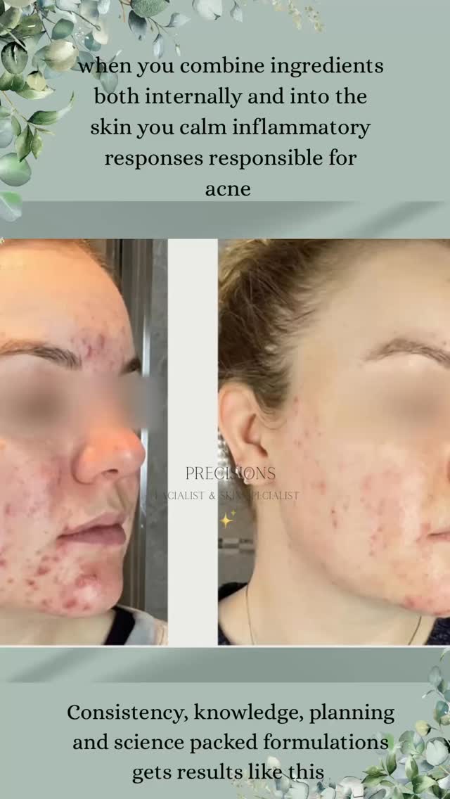 ✨ Struggling with acne that just won’t shift? Your gut might be the missing piece. ✨
Your gut microbiome is made up of trillions of bacteria that help control inflammation, hormones, detoxification and even your immune system.
When it’s balanced → your skin behaves.
When it’s disrupted → breakouts thrive.
So what causes that imbalance?
• Stress
• Antibiotics
• Hormonal changes
• Poor diet / high sugar
• Lack of fibre
• Inflammatory foods
• Alcohol
• Poor sleep
When the gut becomes imbalanced (called dysbiosis), it increases internal inflammation, weakens your gut lining, and disrupts hormone regulation.
And what does inflammation + hormonal imbalance love?
👉 Acne.
If left untreated, you may notice:
• Persistent breakouts
• More cystic / painful spots
• Slower healing
• Increased sensitivity
• Redness and flare-ups
• Skin that stops responding to topical treatments
This is why just treating acne on the surface isn’t always enough.
Supporting your gut with the right targeted supplements, probiotics, fibre and anti-inflammatory nutrition helps:
✔️ Reduce internal inflammation
✔️ Support hormone balance
✔️ Improve nutrient absorption
✔️ Strengthen your skin barrier from within
Clear skin isn’t just about what you put ON your skin… it’s also about what’s happening INSIDE your body.
If you’re constantly chasing breakouts, it might be time we look deeper.
📍Leighton Buzzard
DM “GUT” if you’re ready to support your skin from within 🤍
Picture owned by Awvi our chosen microbiome support brand .
Anna ❤️
#acne #hormonalacne #spots #leightonbuzzard #adultacne