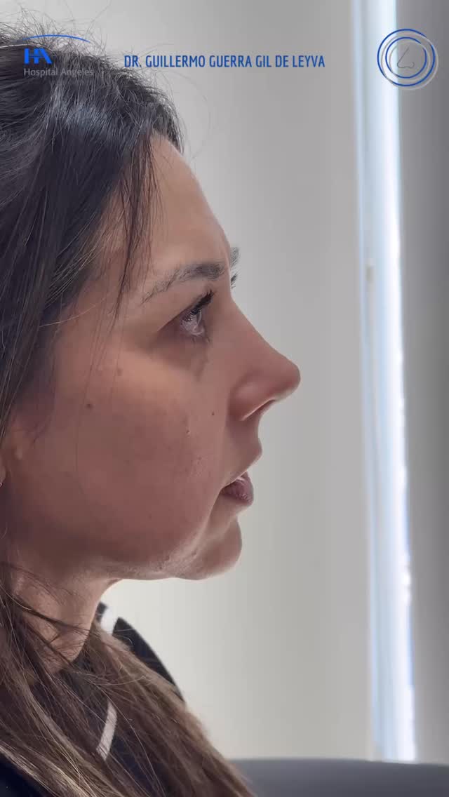 🔹Evolución a un mes de Cirugía Nasal Estética y Funcional.
🔹 Gracias a mi excelente paciente por su confianza y permitir compartir su resultado.
🔹”Made by hand. Crafted with passion”
🧑⚕️ Dr. Guillermo Guerra Gil de Leyva
🏥 Hospital Ángeles Valle Oriente
📱 81-1252-0132
🎓Universidad de Monterrey
👃 Rinoplastia Estética y Funcional
🚫 No taponamiento
Cédula Profesional: 3070499
Cédula Especialista: 4503273
No. Certificación CONACEM: GUG-1748/04
Aviso de Publicidad COFEPRIS: 2419032002A00111
❕Paciente autoriza difusión de imágenes con fines académicos e informativos.
❕Los resultados finales se pudieran observar hasta un año de la cirugía y dependerá tanto del compromiso del cirujano como del paciente, así como del tipo de cirugía, tipo de piel, cuidados post-operatorios, etc.
#RinoplastiaPersonalizada #TuNarizTuEstilo
#rinoplastia #rhinoplasty #nosejob septoplasty rinoseptumplastia rhinoseptoplasty nosejob nose nosesurgery tabiquenasal otorrinolaringologia entsurgery cirugianasal cirugiatabique cirugiaesteticanasal
belleza confianza autoestima
cosmeticsurgery
otorrinolaringologiamonterrey otorrinomonterrey beforeandafter antesydespues
estructuredrhinoplasty
rinoplastiaestructurada
rinoplastiaultrasonica
ultrasonicrhinoplasty
