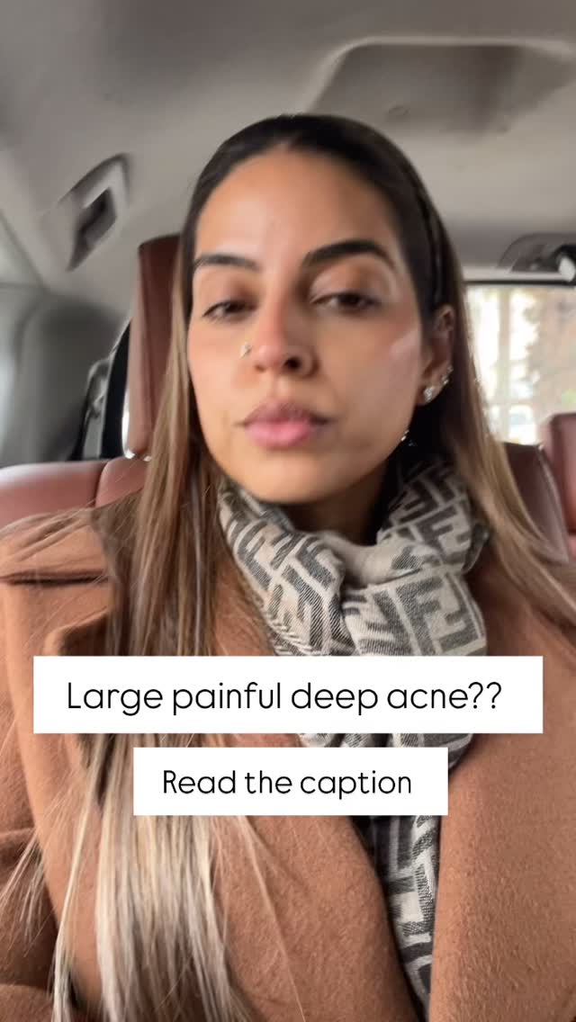 That deep, painful acne spot always shows up uninvited 😩
Here’s what I reach for right away when it happens.
The secret? Patience + consistency.
Stick to this until the skin starts to calm down 👇
• Warm compress — my go-to for easing pain & helping the spot settle
• Cold compress — helps reduce redness and swelling
• Targeted spot treatment — adapalene to help to reduce the inflammation
• Benzoyl peroxide — helps control acne-causing bacteria
#acne #blindpimple #acnehelp #acneproneskin #acnetreatment skincarecommunity skinhealing