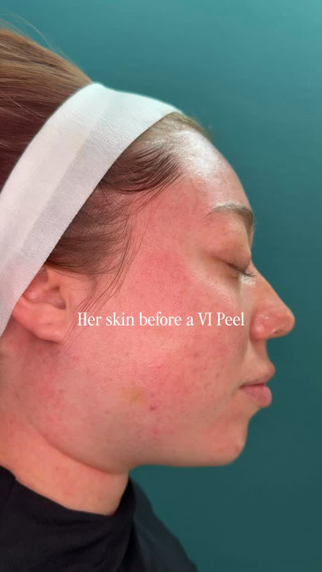 She came in concerned with uneven tone, redness, mild congestion, and pores that always seemed more noticeable no matter what products she tried at home. These are all signs the skin cycle has slowed and buildup is sitting on the surface.
After her VI Peel, you can see the difference: smoother texture, more even tone, clearer pores, and overall brighter, healthier-looking skin. A chemical peel works by encouraging controlled exfoliation and stimulating new, fresh skin to come forward, essentially giving the skin a chance to function the way itâs supposed to again.
Sometimes the best results donât come from adding more skincare⌠they come from helping the skin start over. Have questions about peels or wondering if your skin is a good candidate? Send us a message! đ¤
Glamhouse Aesthetics & Wellness | New Braunfels | New Braunfels MedSpa | San Antonio MedSpa | VI Peel | Chemical Peel