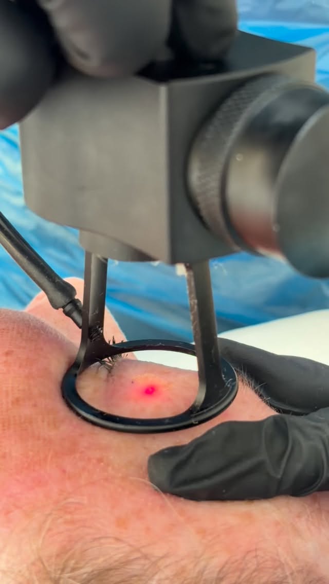 Eyelid skin tightening using our co2 laser treatment. Models needed 🫶🏼 #aestheticsderby #co2laser #co2laserskinresurfacing #co2laserskin #co2laserderby