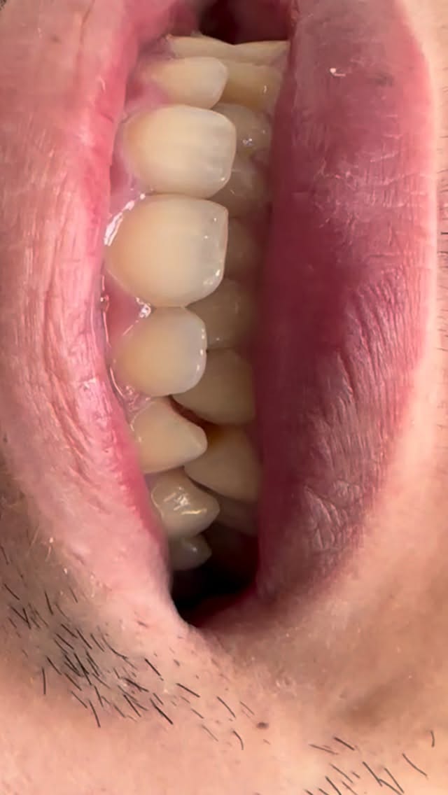 #dentistacuranilahue #blanqueamiento #curanilahue #clinicadentalcuranilahue #Odontologiacentral