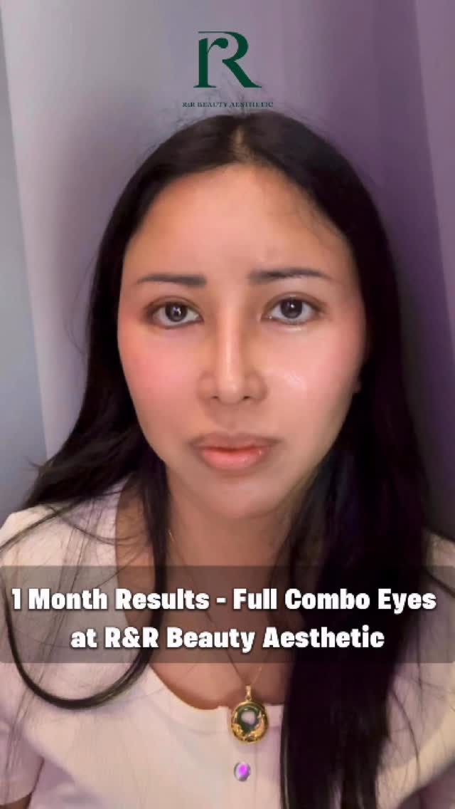 Combo eye results after 1 month.
Fix. Drops eye + fix muscle + bigger eye #medicaltourism #plasticsurgery #fatremoval #cosmeticsurgery