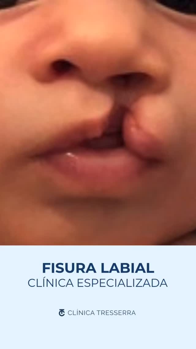 💙 Detrás de cada antes y después hay una historia.
Este caso nos recuerda algo muy importante:
una fisura labial no define el futuro de un niño.
Con el tratamiento adecuado, el acompañamiento de la familia y un equipo especializado, muchos niños crecen, sonríen y viven una vida completamente normal.
Cada pequeño avance es un paso enorme para ellos… y para nosotros también.
💬 Si eres madre, padre o conoces a alguien que esté pasando por este momento, comparte este mensaje. A veces lo que más necesitamos es saber que hay solución y no estamos solos.
#FisuraLabial #FisuraLabioPalatina #CirugíaReconstructiva #ClínicaTresserra #HistoriasQueInspiran