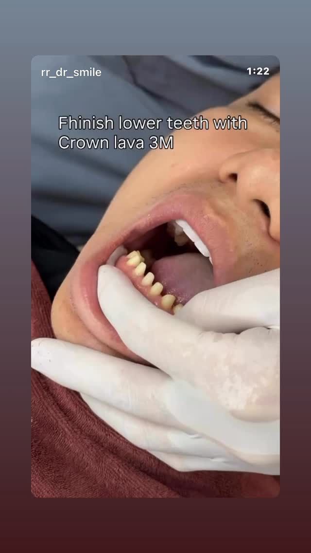 Dental Crown is a porcelain cap that fully covers the natural tooth above the gum line. This method helps restore the shape, chewing function, and aesthetics of a damaged tooth.
When is a dental crown recommended?
Commonly used in the following cases:
• Large cavities or severely broken teeth
• Teeth that have undergone root canal treatment
• Weak, worn, or cracked teeth
• Severely discolored teeth that cannot be whitened
• To change the shape and color of teeth for aesthetic improvement
Advantages of dental crowns
• Restores strong chewing function
• Protects the natural tooth structure inside
• Improves tooth shape and color
• Durable and long-lasting solution
High-quality porcelain crowns also have excellent translucency, allowing them to reflect light like natural teeth. This creates a more natural, lifelike smile without a dull or artificial appearance.
#dental_clinic #venner #dentallcrown #crownteetn
