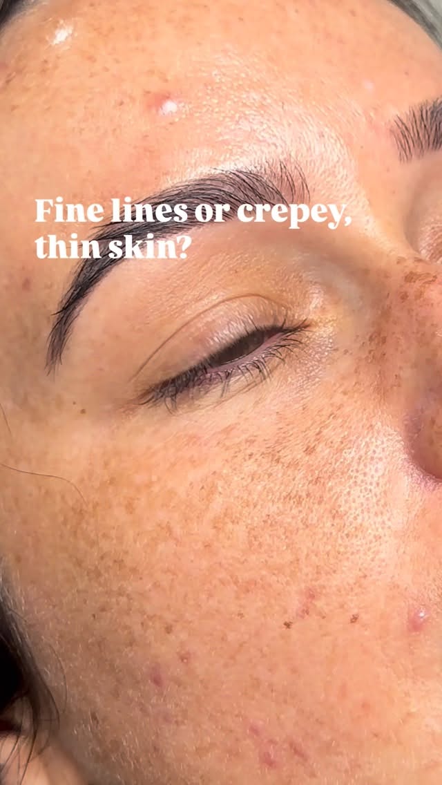 Rejuran treatment for the under-eye area, a polynucleotide treatment designed to support skin repair and overall skin quality.
Available at Forme Aesthetics.
Bookings available via the link in bio.