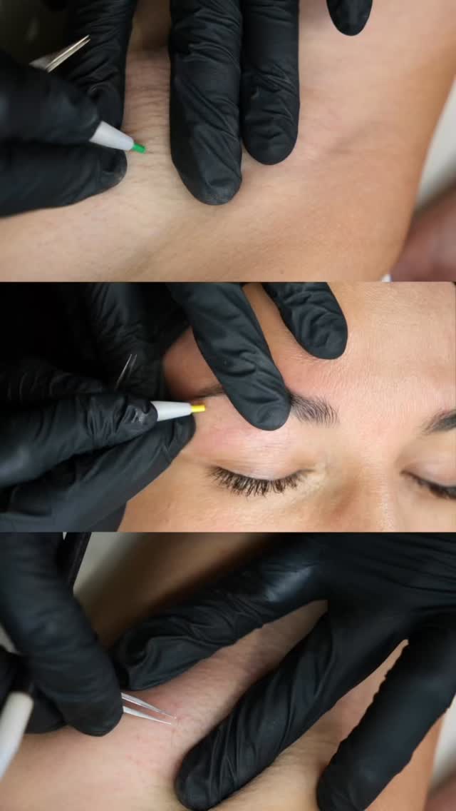 Ilona pratique l’épilation définitive au sein du centre avec Apilus, la référence en électrolyse haute précision.
Grâce à cette technologie, elle traite chaque poil individuellement pour un résultat ciblé, sûr et durable.
Idéal pour :
• Poils clairs, blancs ou roux
• Zones hormonales (menton, lèvre…)
• Retouches après laser
• Petites zones nécessitant une extrême précision
Une solution efficace là où le laser ne fonctionne pas.
#apilus #electrolyse #epilationdefinitive #dermoesthetique