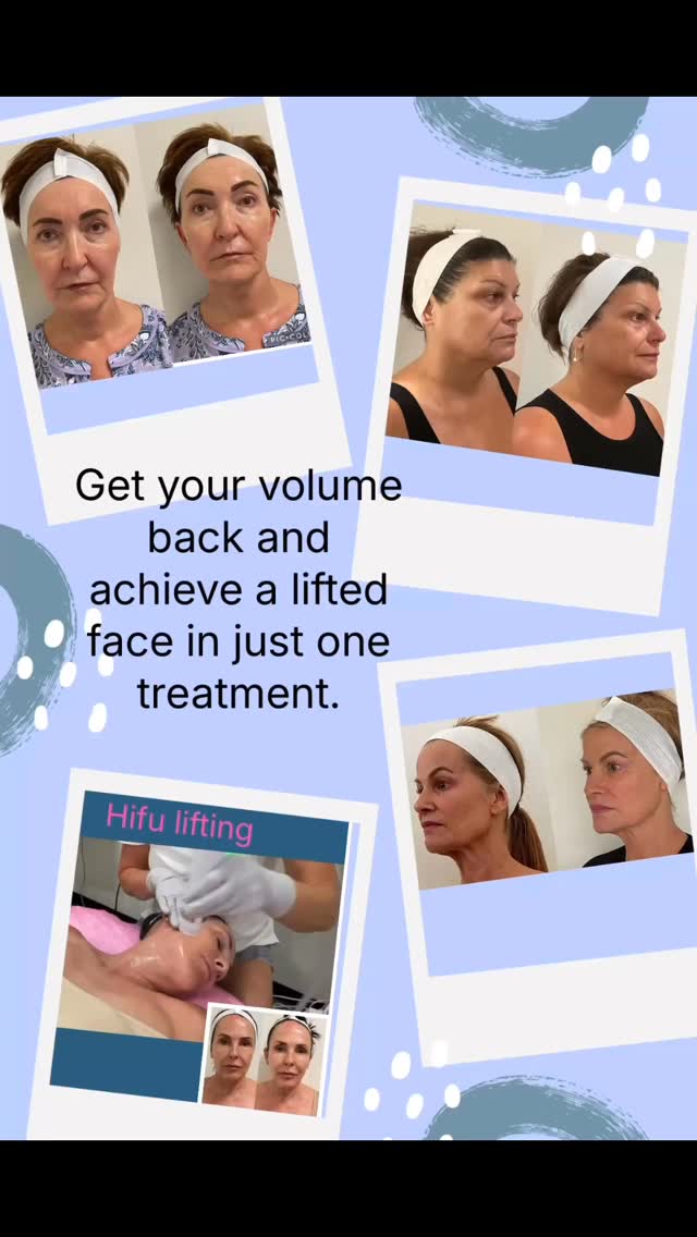 Loss of facial volume can give the face a more wrinkled, older appearance and sunken cheeks
HIFU will help to restore volume and give you more lifted look..
Book you appointment today for you free consultation..and get 25% off you treatment
#sarasotaflorida #hifusarasota #medspasarasota #age #capricebeautybar
http://Capricebeautybar.com/
