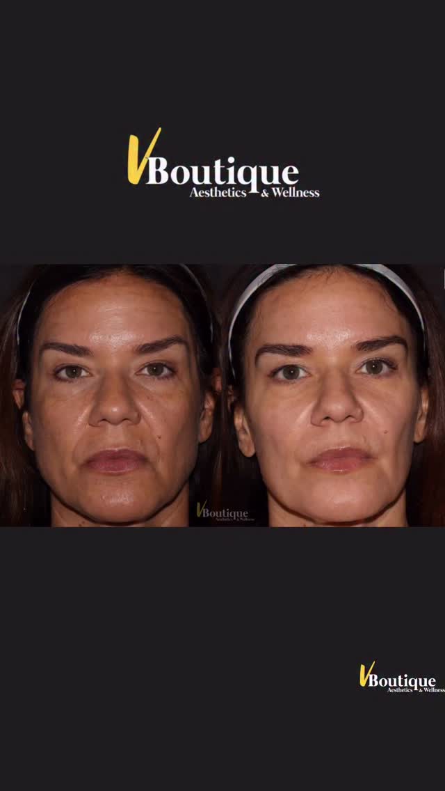 ✨ Melasma is one of the hardest skin conditions to treat… and one of the easiest to make worse.
Melasma isn’t just pigment sitting on the skin. It’s a hyper-reactive pigment disorder triggered by hormones, sun exposure, inflammation, and even heat. That’s why many lasers and aggressive treatments can backfire and make it darker.
This is where technology — and experience — matter.👩⚕️
For this patient we used the Fotona StarWalker melasma protocol, one of the few laser systems designed to treat pigment without overheating the skin.
The protocol includes pico laser technology, which breaks up pigment into microscopic particles so the body can clear it naturally — while keeping the skin calm and safe.
But beautiful results rarely come from one treatment alone.
To enhance her overall expression we carefully combined:
💉 Dysport to lift the brows, soften lines, and create a brighter, happier look
💉 Masseter Dysport to relieve jaw clenching and slim the lower face
✨ Strategic placement of hyaluronic acid filler in the cheeks, nasolabial folds, and marionette lines to restore support and gentle lift — without adding heaviness
The goal is never to change a face.
It’s to reveal the most refreshed, balanced, and natural version of it.
Her pigment is dramatically improved, her skin is glowing, and the entire face feels lighter and more harmonious. ✨
Melasma is a journey though — and long-term success always includes:
☀️ Sun protection
🧴 Medical skincare
🔁 Maintenance
#melasma #fotonalaser #melasmalaser #naturalaesthetics #skinconfidence
