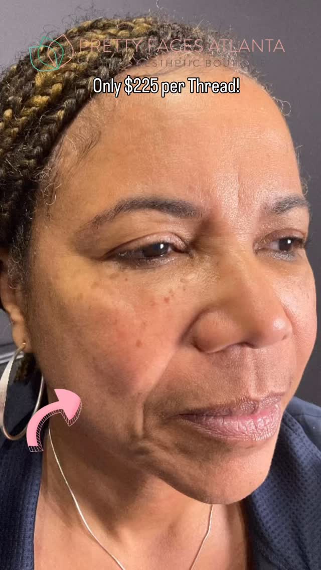 Turn back the clock without surgery ✨
PDO Threads are the secret to lifting, tightening, and rejuvenating your skin naturally. These dissolvable threads stimulate collagen while instantly lifting areas like the cheeks, jawline, and neck for a smoother, firmer appearance.
The best part? Your results continue to improve as your body produces new collagen over time.
This month only, take advantage of our PDO Thread Sale for just $225 per thread and start your transformation today.
If you’ve been thinking about lifting and tightening your skin, now is the time.
#PDOThreads #SkinTightening #CollagenBoost #AestheticTreatments #PrettyFacesAtlanta