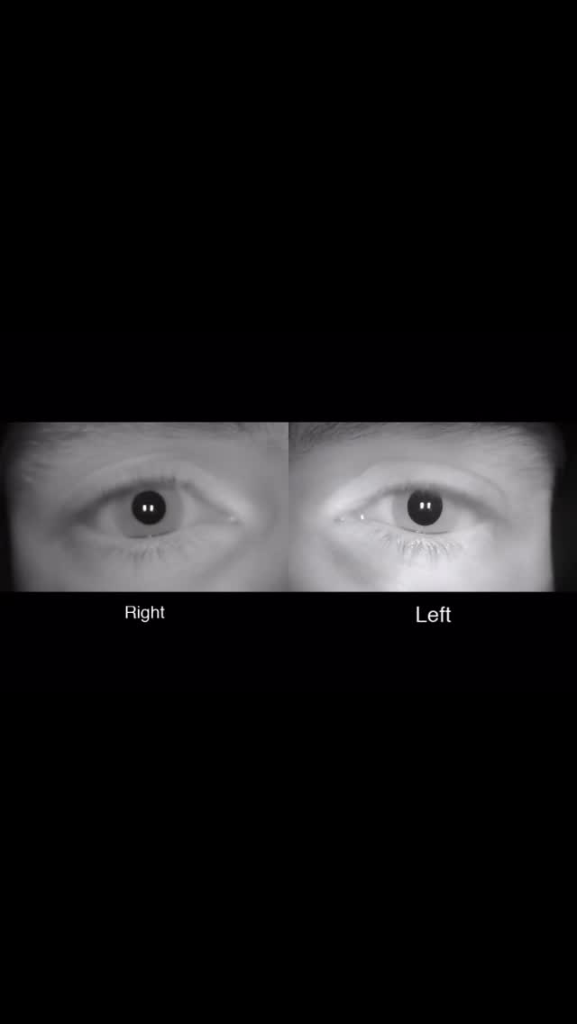 Feeling dizzy… but being told “everything looks normal”?
Here’s something most people don’t know 👇
Around two-thirds of abnormal eye movements go undetected during standard bedside testing.
But your eye movements are one of the most important windows into your vestibular system and brain.
Using infrared (IR) video goggles (VOG) we can detect subtle abnormal eye movements that are often missed — giving us objective, measurable data to guide diagnosis and treatment.
At Optimize Sports Chiropractic, we utilize:
✔️ Computerized eye movements
✔️ Infrared vestibular goggles (Video Oculography)
✔️ Force-plate balance testing
Because when it comes to dizziness, guessing isn’t good enough.
Objective. Measurable. Essential.
If you’re experiencing:
• Vertigo
• Persistent dizziness
• Post-concussion symptoms
• Unsteadiness or balance issues
A comprehensive vestibular assessment may be the missing piece.
📍 720 Nicholson Street, Fitzroy North
📞 (03) 9486 4111
📩 reception@nhaw.com.au
Book your vestibular assessment today.
#dizziness #vestibularrehab #vertigo #postconcussion #sportschiropractic