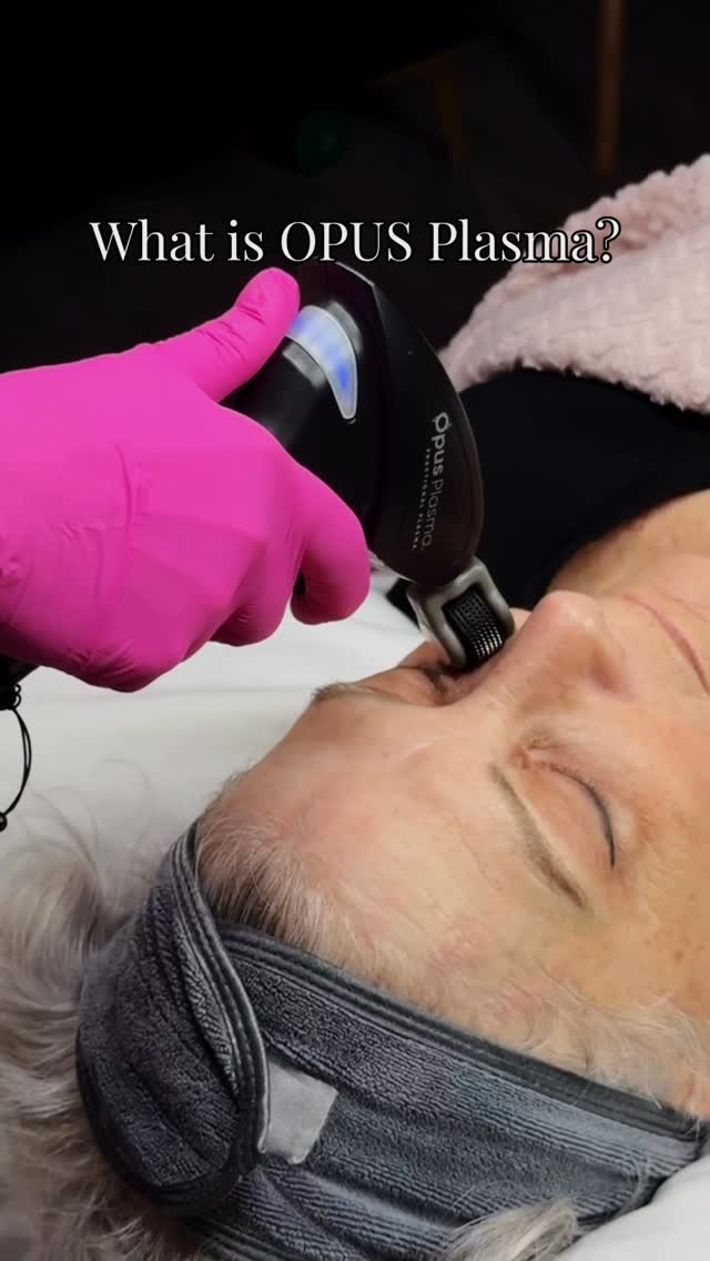 If you’ve been wanting smoother skin in real lighting, start here.
Sun damage, texture, pores, fine lines, pigmentation, laxity… this is what Opus Plasma is built for ✨
Follow for more treatment breakdowns and message us for honest guidance. 💬
————————
Smooth Secret RN 💋 It’s our Secret
Jo-Lynn Gibbs RN, BScN + Pailey Corbett RN, BScN
#SkinResurfacing #SherwoodParkAesthetics #OpusPlasma
