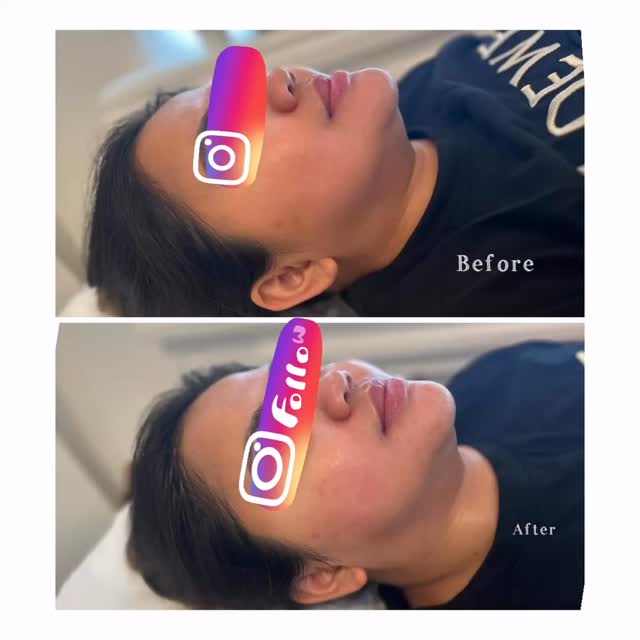 Want a lifted, contoured look — without surgery? 💆♀️✨
HIFU (High-Intensity Focused Ultrasound) uses advanced ultrasound energy to tighten skin, lift sagging areas, and define your jawline naturally.
✔ Non-invasive
✔ No downtime
✔ Stimulates collagen
✔ Gradual, natural results
Perfect for lifting the cheeks, tightening the jawline, and reducing double chin.
📩 DM us to book your consultation!
#HIFU #FaceContouring #NonSurgicalLift #SkinTightening #AestheticClinic