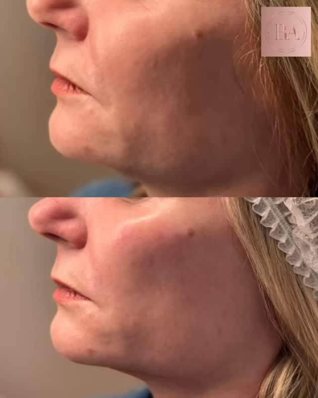 Restoring balance while keeping results beautifully natural ✨
This treatment focused on gently enhancing the cheeks and chin to improve facial harmony and support the natural structure of the face. By carefully placing dermal filler, we can restore lost volume, improve hydration within the skin, and create subtle definition that refreshes the overall appearance.
What I love most about this approach is how refined the results can be. Nothing overdone, nothing obvious—just thoughtful, precise treatment that helps the face look balanced, supported and naturally rejuvenated.
Subtle changes can make such a meaningful difference, and it’s always a privilege to help patients feel confident while still looking completely like themselves.
Results like this are why I love what I do 🤍
#SubtleEnhancement #FacialHarmony #DermalFillers #NaturalResults #AestheticMedicine