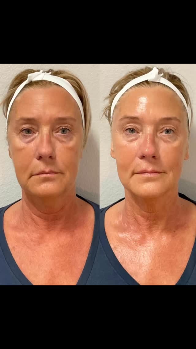 #capricebeautybar #sarasotaflorida #medspa #hifu #co2
Restored volume ,lifted glowing skin …
GET YOU V LIFT HIFU FOR LIFTED SKIN AND RESTORE VOLUME ON YOU FACE
Schedule you V LIFT HIFU today and get 25% OFF your treatment..
Capricebeautybar.com