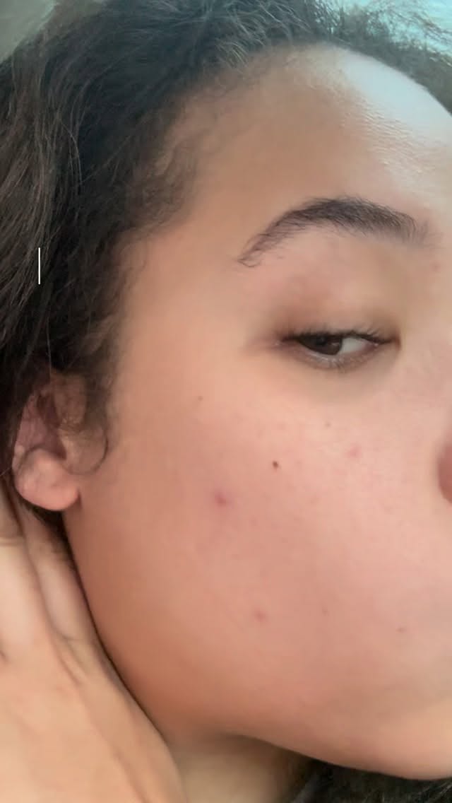 Consistency is key. ✨
Just last week my skin was breaking out — with consistent use and the right products, my skin has already started clearing up.
Pearl Cream has been a game changer for targeting breakouts and improving the look of hyperpigmentation. Consultations are required before starting Pearl Cream to make sure it’s right for your skin.
Tap the link in our bio to learn more or book a consultation.
#PearlCream #ConsistencyIsKey #AcneJourney #PrettyFacesAtlanta #Hyperpigmentation