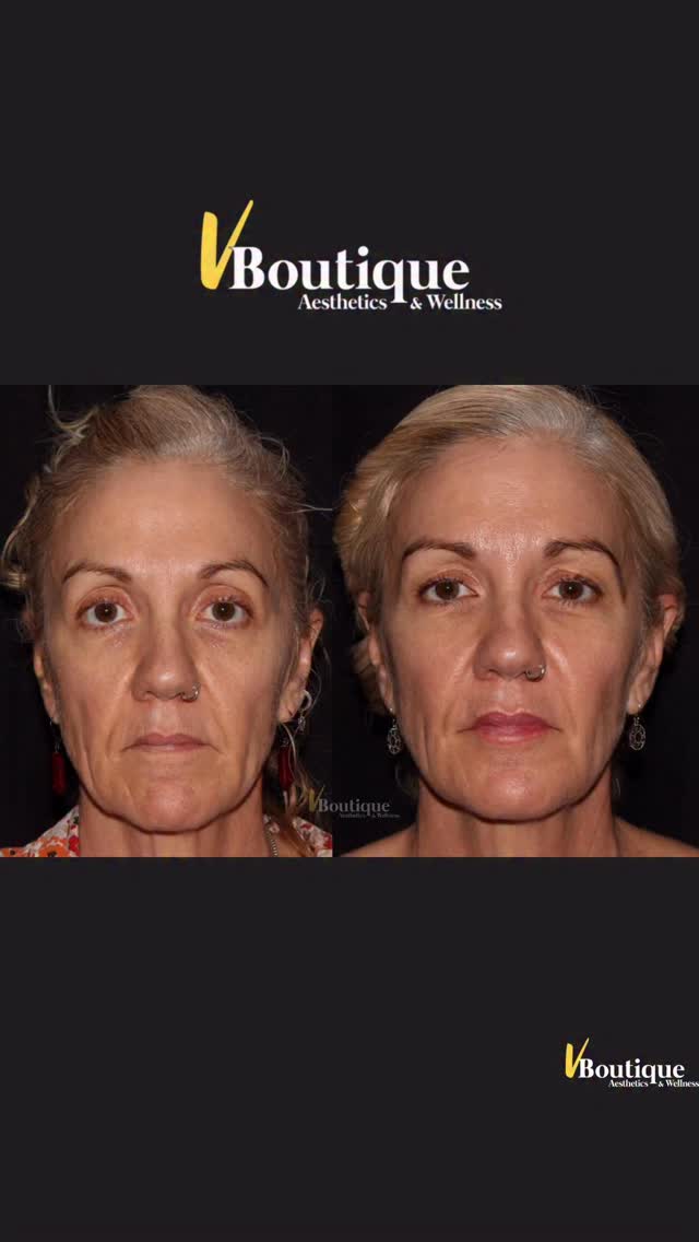 ✨ 6 YEARS APART… and aging didn’t win!
This beautiful patient proves that aging can be slowed — and even partially reversed — with consistent, thoughtful treatments over time👍🏻
💉 Sculptra has been a key part of her treatment plan.
Unlike traditional fillers, Sculptra stimulates your own collagen production, gradually restoring lost volume and improving skin quality. Over time it creates a subtle “Spanx-like” tightening effect while rebuilding the structure of the face.
💉 Dysport helps lift and reposition tissues by relaxing the muscles that pull the face downward — supporting the jawline and neck, lifting the brows.
💉 Occasional hyaluronic acid filler keeps lips and marionette lines balanced and natural.
✨ IPL (Intense Pulsed Light) treatments improve redness, sun damage, and brown spots while also stimulating collagen for brighter, healthier skin.
The result after years of care:
✨ Glowing skin
✨ Proportional volume
✨ Looking refreshed and younger — without looking different
Consistency always beats quick fixes.
#Sculptra
#CollagenStimulator
#IPLPhotofacial
#NaturalRejuvenation
#aginggracefully