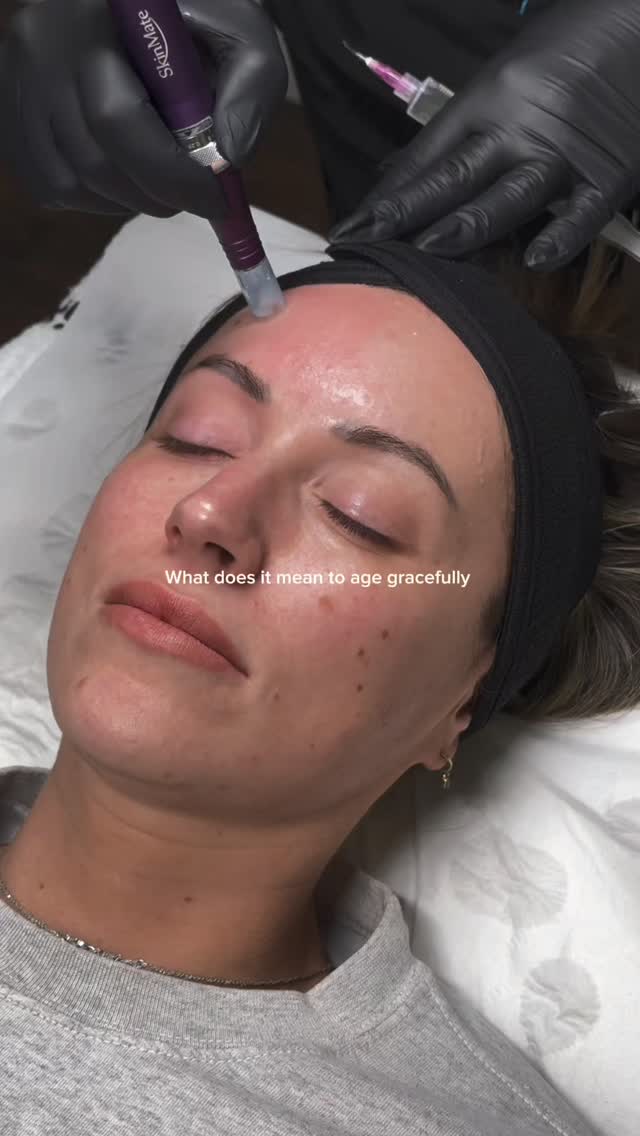 ✨ WHAT DOES IT MEAN TO GROW OLD GRACEFULLY? ✨
Growing old gracefully doesn’t mean doing nothing. It means being intentional about how you care for your skin over time.
The women who understand this know that great skin is about consistency, not quick fixes.
It’s a strategy.
✨ A course of 3–4 microneedling treatments to stimulate collagen
✨ Quarterly muscle relaxing treatments to soften expression lines
✨ AesPlla treatments to support long-term skin quality
✨ Medical-grade skincare that actually works with your skin
✨ Daily SPF to protect the results you’re investing in
✨ Lip filler once a year for subtle balance and hydration
✨ Facials in between to maintain healthy, glowing skin
Ageing gracefully isn’t about changing your face.
It’s about maintaining healthy skin, supporting collagen, and making small, consistent investments that keep you looking like the best version of yourself.
Strategic. Subtle. Consistent.
Just saying…
#ageinggracefully #aestheticstrategy #microneedling #aestheticswarrington #warringtonaesthetics