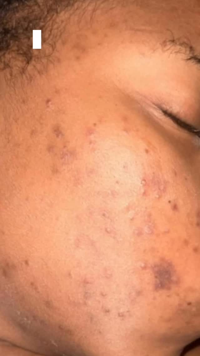 Spring is the perfect time for a skin reset ✨
Our Laser Skin Renewal Packages are designed to clear redness, smooth texture, and bring your natural glow back just in time for the new season.
Choose your transformation:
1 Treatment • $500
2 Treatments • $550
3 Treatments • $800
More sessions mean deeper correction and longer lasting results. If you have redness, acne marks, uneven tone, or dull skin, this is one of the most effective ways to completely refresh your skin for spring.
Appointments are limited this month. DM “LASER” or call Pretty Faces Atlanta to reserve your package.
#PrettyFacesAtlanta #LaserSkinTreatment #AtlantaMedSpa #SkinRejuvenation #SpringSkinReset ✨