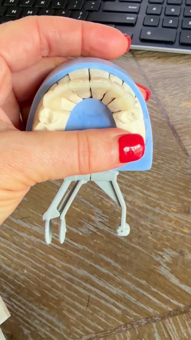 Dr. Lohr LOVES to do cosmetic dentistry! 🦷 💜 Here is a recent case done for a patient who desired an improved smile. She did not like her front teeth due to crowded positioning, old stained white tooth colored fillings, and a darker base shade. After bleaching the lower arch and repositioning with clear aligner therapy, we prepped her six front teeth for beautiful all ceramic crowns! 👑 Functional and esthetic! We will be sharing her before and after photos soon! #lohrfamilydentistry #cosmeticdentistry #drlohrdds #siouxcitydentist #implantdentistry