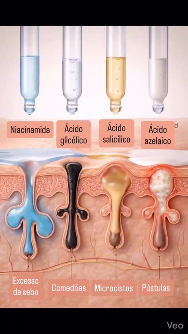 Sua pele fala e cada ativo atua em um problema diferente. 🧪✨
Quando entendemos o que está acontecendo dentro da pele, conseguimos escolher os ativos certos para tratar cada condição de forma mais eficaz:
🔹 Niacinamida → ajuda a controlar o excesso de sebo, melhora a barreira da pele e reduz a oleosidade.
🔹 Ácido glicólico → promove renovação celular, ajudando a desobstruir poros e melhorar comedões (cravos).
🔹 Ácido salicílico → penetra nos poros e é excelente para tratar microcistos e acne, reduzindo inflamações.
🔹 Ácido azelaico → atua na inflamação e nas pústulas, além de ajudar a melhorar manchas e vermelhidão.
Mas atenção:
⚠️ Nem todo ativo é indicado para todos os tipos de pele e o uso inadequado pode causar irritação ou piorar o quadro.
Por isso, o ideal é sempre ter orientação dermatológica para escolher a combinação correta de ativos para a sua pele.
💬 Você já usa algum desses ativos na sua rotina de skincare?
Dr Emmanuel França
Dermatologista
CRM 5999
RQE 636
📍Skin Prime - Riomar Trade Center - Torre 3 - Sala 1905
☎️ (81) 3036-4040