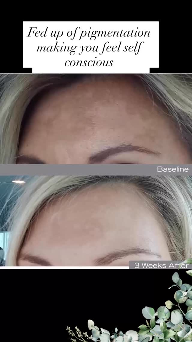 If you are vulnerable to pigmentation start on these products TODAY!
I had pigmentation, I hated it. I once had someone try to wipe off the darker brown areas in my forehead whilst asking “what is that on your head”
Not anymore, after using the correct ingredients from Noon aesthetics and protecting my skin I kicked its BUTT 🙌🏻
When we feel better and more confident we can focus on our day, not having that niggling voice saying” they are staring at you, thinking people think you have got chocolate around your 💋 “ etc
These products block the signals which switch enzymes in our skin to produce extra melanin.
Any skin tone is susceptible to pigmentation!
SPF is a must, zero negotiation room
Please don’t leave it any longer, it takes your skin a while to rewire . Start now , be summer ready , free to enjoy your holiday, swimming , sweat without foundation streaking down your face.
DM to book your plan to even tone skin
Anna ❤️
@noonaesthetics
#pigmentstion #sunspots #leightonbuzzard #holidayskin #hyperpigmentation