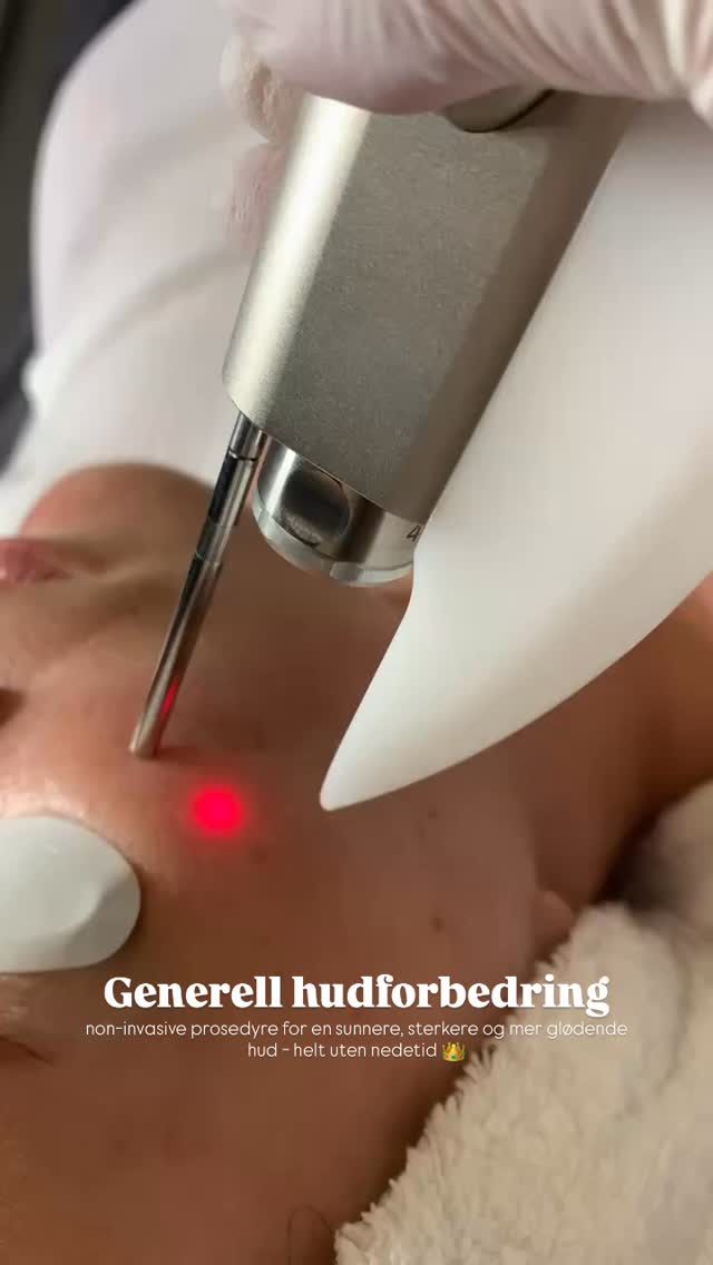 Redness Reset gir huden din en ny start – helt uten nedetid 🩷
👉🏼 styrker hudbarrieren
👉🏼 roer ned rødhet og inflammasjon
👉🏼 regulerer talgproduksjon og strammer lett opp porer
👉🏼 gir en mild kollagenboost
👉🏼 styrker hudens naturlige reparasjon
👉🏼 forbedrer hudtonen og reduserer diffus rødme
👉🏼 bidrar til sterkere og mer motstandsdyktig hud
👉🏼 super behandling ved akne, rosacea og andre inflammatoriske hudtilstander
🍀 Perfekt å kombinere med behandling av synlige blodkar
