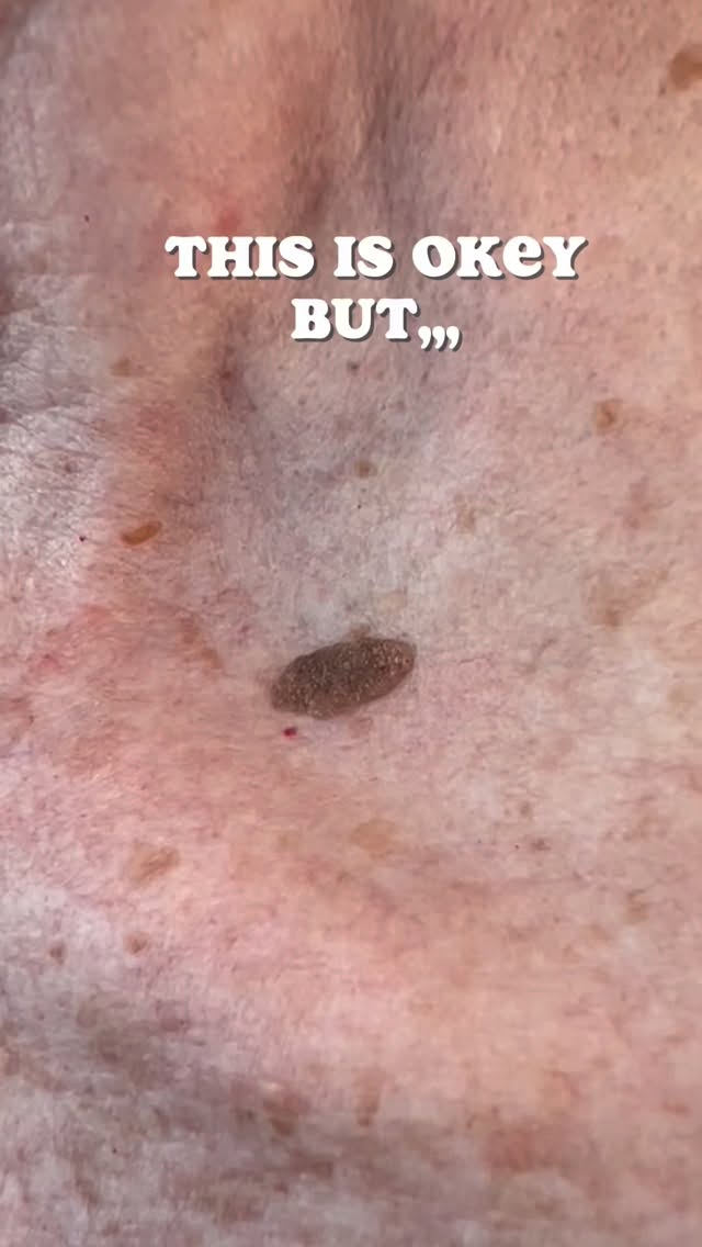 Key Facts About Seborrheic Keratosis
Not Cancerous: SKs are not skin cancer, nor do they turn into it.
Appearance: They can be smooth or rough, waxy, and range in color from light tan to black. They often look as if they were “pasted” or “stuck” onto the skin.
Location: Common on the face, neck, chest, and back; they do not appear on palms or soles.
Symptoms: Generally asymptomatic, but can itch, become inflamed, or bleed if irritated by clothing.
Causes: The exact cause is unknown, but they are strongly linked to aging, genetics, and potentially sun exposure.
Treatment: these can easily be removed using a plasma pen.
#trowbridge #warminster #westbury #frome #hilperton