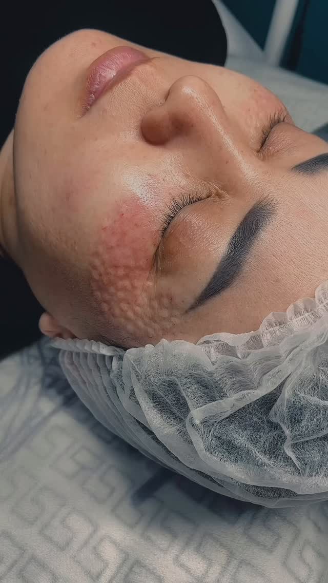 ✨ Biorevitalisierung der Augenpartie
Die Haut rund um die Augen ist besonders dünn und empfindlich. Mit der Zeit können Trockenheit, feine Linien, Müdigkeitszeichen und dunkle Schatten auftreten.
💧 Biorevitalisierung ist eine sanfte Injektionsbehandlung mit Hyaluronsäure, die die Haut intensiv mit Feuchtigkeit versorgt und ihre natürliche Regeneration aktiviert.
Vorteile der Behandlung:
• tiefgehende Hydration der Haut
• Reduzierung von feinen Fältchen
• frischere und strahlendere Augenpartie
• Verbesserung von Hautelastizität und Hautstruktur
Die Behandlung dauert etwa 20–30 Minuten, ist minimalinvasiv und erfordert kaum Ausfallzeit.
🌿 Schon nach wenigen Tagen wirkt die Haut frischer, glatter und besser hydratisiert.
📩 Für Beratung oder Terminvereinbarung schreiben Sie mir gerne eine Nachricht.
#deincosmetologist #rottenburg #rottenburgamneckar #ästhetischemedizin #beautyrottenburg