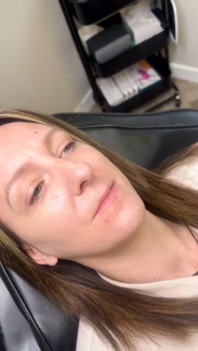 Understanding lip anatomy is key to achieving beautiful, natural results.
This client presented with M-shaped lips, where the cupid’s bow is more pronounced and the centre of the lip naturally dips. Overfilling this type of lip can quickly distort the shape.
For that reason, we started with 0.5ml of filler, focusing on:
• supporting the natural shape
• improving balance
• subtle projection
Lip enhancement should be strategic, gradual and tailored to the individual.
Please book your treatments in advance as our available slots are very limited. Appointments can be booked online at
www.ceteaesthetics.co.uk
——
#scunthorpeaesthetics #dermalfiller #mshapelips #lincolnshireaesthetics #nurse