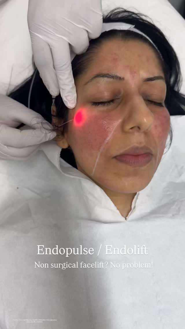 ENDOPULSE / ENDOLIFT is a minimally invasive, non-surgical laser treatment used for skin tightening, fat reduction, and body contouring.
It uses diode laser technology delivered via micro-optical fibers beneath the skin to stimulate collagen and melt fat, primarily targeting the face, neck, and body.
The procedure is performed under local anesthesia with minimal downtime, often used as an alternative to traditional lifts.
Key details about Endopulse:
Target Areas: Treats the neck, lower face, jawline, chin, upper/lower eyes, arms, and stomach.
Procedure: A thin, hair-like fiber is inserted beneath the skin, delivering laser energy to tighten tissue and reduce localized fat deposits.
Benefits: Promotes collagen production, improves skin elasticity, and contours areas affected by aging.
Recovery: The procedure typically takes 30-60 minutes, with side effects limited to mild swelling or bruising that resolves in a few days.
Treatments start for £1200. Klarna available.
Results last up to 2-3 years.
Book your treatment / consultation today.
#endolift @priceofperfectiontv #endosculpt #skintightening #skinlifting