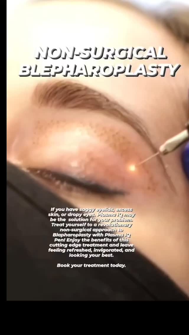With Non Surgical Blepharoplasty, you can now bring life and beauty to your eyes using the latest technology of Plasma IQ. Refresh your look without any invasive surgery!
PLASMA IQ FIBROBLAST SKIN TIGHTENING
🎯Purpose: tightening, Lifting & Rejuvenate Skin.⠀
💥Treatment time: 1-2.5 hrs⠀
💥Downtime: 4-7 days for the scabs to fall off⠀
💥Healing time: 12 weeks to see full results⠀
💥Results last 3-4 years ⠀
✏Note: individual results may vary⠀
📱Phone: (212) 920 7363
📧Email: Info@beautybystefany.com ⠀
🌍Website: www.Beautybystefany.com ⠀
💻Book Online and Virtual Consultation available
🧬Technique: Plasma IQ
🤓Anesthesia: Topical Anesthetic Cream⠀
😱Pain Level: mild to none⠀
📍Location:
BEAUTY BY STEFANY
Follow @plasmapenbystefany
Hablo espanol.
Agenda tu cita
⠀⠀
⠀🎯Fibroblast-Skin Tightening treatment is NON-invasive or NON-surgical procedure where no scalpels or any surgical instruments are used.⠀Fibroblast is basically an electrical arc that is transmitted through a small probe. This innovative technology cannot cause the so-called “over lifting”, as it only affects excess/loose skin which returns to its “original state”
**All photos posted are of real patients who have signed consent to have their pictures posted
All photos are property of Aesthetics BY Stefany and are not to be duplicated or reproduced by any other party***
#eyelids ##eyelift #plasmapen #plasmafibroblast #PlasmaIQ