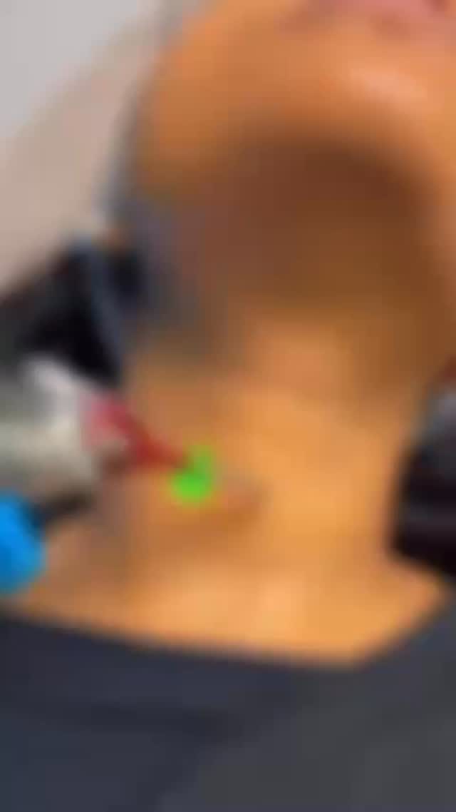 DEKA - What’s the Hype About
Deka is a professional dual-wavelength laser platform used to treat a range of aesthetic skin issues - including skin rejuvenation.
It uses both Alexandrite (755 nm) and Nd:YAG (1064 nm) laser wavelengths to deliver energy into the skin.
🌟 Key Features ✔ Dual wavelength system: • Alexandrite is effective on superficial targets. • Nd:YAG penetrates deeper into the skin.
This combo enables a versatile approach to skin texture and tone.
✔ Moveo Technology: This DEKA-exclusive contact technique lets the laser deliver heat more evenly and with less reflected energy - meaning enhanced comfort and safety, including darker or tanned skin types.
✔ Multiple applications: Apart from skin rejuvenation, Again is also used for hair removal, vascular lesion treatment, and pigmented lesions - but the Moveo SR setting specifically targets rejuvenation by stimulating collagen production deep in the dermis.
🧴 What It Does for the Skin 📌 Collagen stimulation & tightening – Controlled heat stimulates neocollagenesis (new collagen creation).
📌 Improves skin texture & firmness - Leads to smoother, more resilient skin.
📌 Treats all skin types, including darker or tanned skin (Fitzpatrick I–VI). 📌
Little to no downtime – Often described as a “lunchtime rejuvenation” because you can resume normal activities soon after treatment