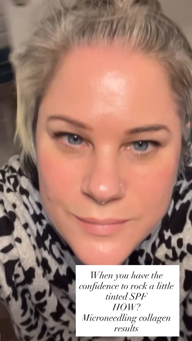 Microneedling is often talked about for collagen… but its real power is how it helps rebuild the skin’s structure.
Using controlled micro-injuries, Microneedling stimulates your skin’s natural repair response. This encourages the production of collagen and elastin, strengthening the skin from within and improving its overall structure.
What many people don’t realise is that when done consistently, microneedling can transform the quality of your skin — helping it become:
✨ stronger
✨ more resilient
✨ plumper
✨ smoother
✨ more radiant
It’s not just a treatment for lines or acne scars — it’s a powerful skin health treatment that helps rebuild and support your skin over time.
If you’re looking to boost your skin’s natural strength and glow, microneedling could be the perfect treatment for you.
✨ Book your consultation today:
www.precisions.org.uk
❤️ Anna
#leightonbuzzardskintherapist #microneedling #leightonbuzzard #makeupfree #clearskin