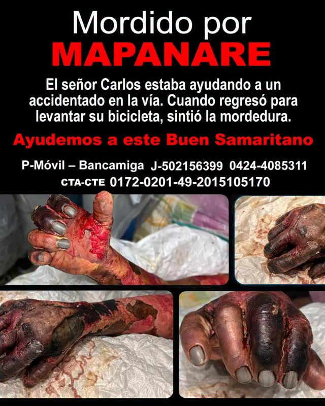 Hace 9 días, Carlos Rodríguez (65 años) fue mordido por una serpiente mapanare (Bothrops) en el estado Portuguesa.
Pero lo que pocos saben es cómo ocurrió...
El señor Carlos se encontraba ayudando a una persona que había sufrido un accidente en la vía, entre Gavilán y La Atenea, cerca del complejo habitacional Simón Bolívar.
Dejó su bicicleta a un lado de la carretera mientras prestaba ayuda.
Cuando regresó para levantarla, sintió la mordedura.
No logró ver la serpiente.
Desde ese momento comenzó una lucha que hoy continúa en el hospital.
Actualmente el paciente enfrenta una lesión grave en su brazo producto del envenenamiento botrópico, y requiere:
• curas diarias
• procedimientos de debridación
• medicamentos continuos
• vigilancia médica constante
Su familia ha estado cubriendo los gastos del tratamiento durante estos días, pero la situación ya se les está haciendo difícil económicamente.
Desde la Fundación Vivarium estamos acompañando a la familia brindando orientación médica y ayudando a difundir el caso.
Tú también puedes apoyar:
📌 Pago Móvil – Bancamiga
J-502156399
0424-4085311
📌 Cuenta Corriente
0172-0201-49-2015105170
📖 Análisis completo del caso en nuestro blog: 👇fundacionvivaium.org/blog
(link en bio)
#AccidenteOfidico
#Mapanare
#MordeduraDeSerpiente
#FundacionVivarium
#SaludPublica
Venezuela