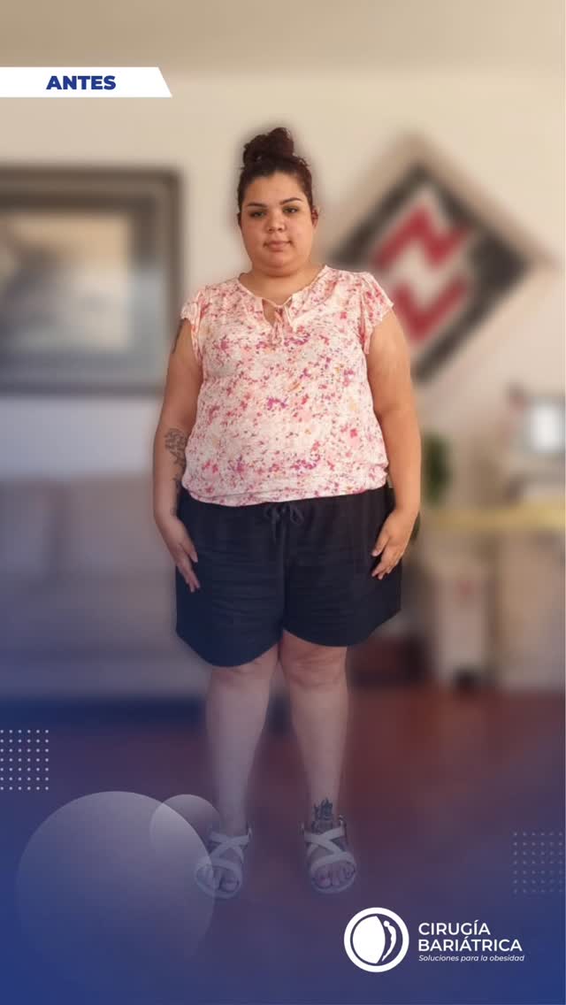 ##cirugiabariatrica#transformación
#beauty#vidasaludable
DrEduardoBolañossalud
bienestarbariatricsurgery
weightlossweightlossjourney
gastricsleeve
weightlosstransformation
vsgcommunityweightlosssurgery
beforeandaftervsgwls